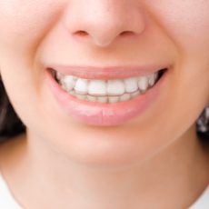 אישה מחייכת עם שיניים מושלמות ובריאות באמצעות פלטה נשלפת וגשר שקוף